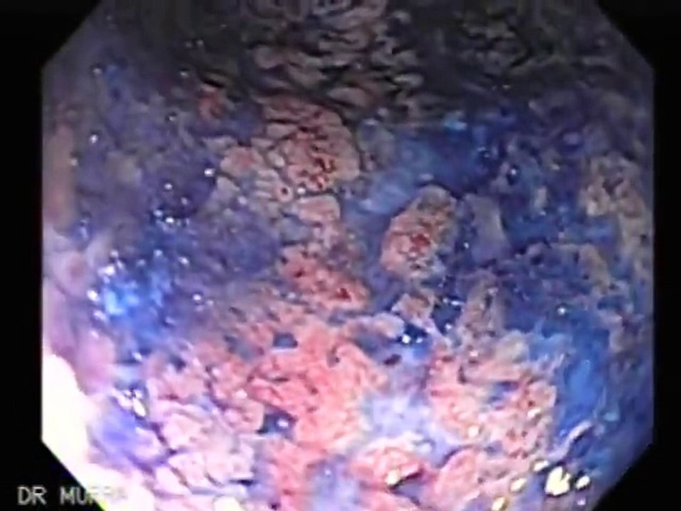 Colonoscopia Colitis Ulcerosa
