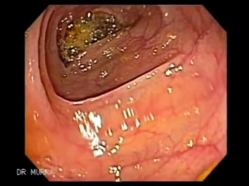 Colonoscopia de Cancer del Colon y Polipos Grandes