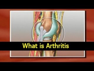 Tải video: What is Arthritis - Causes, Symptoms, Treatments and Diet Tips in English