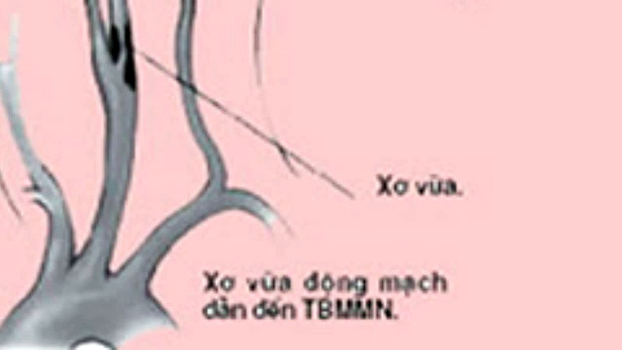 Thiểu năng tuần hoàn não bệnh học là gì?