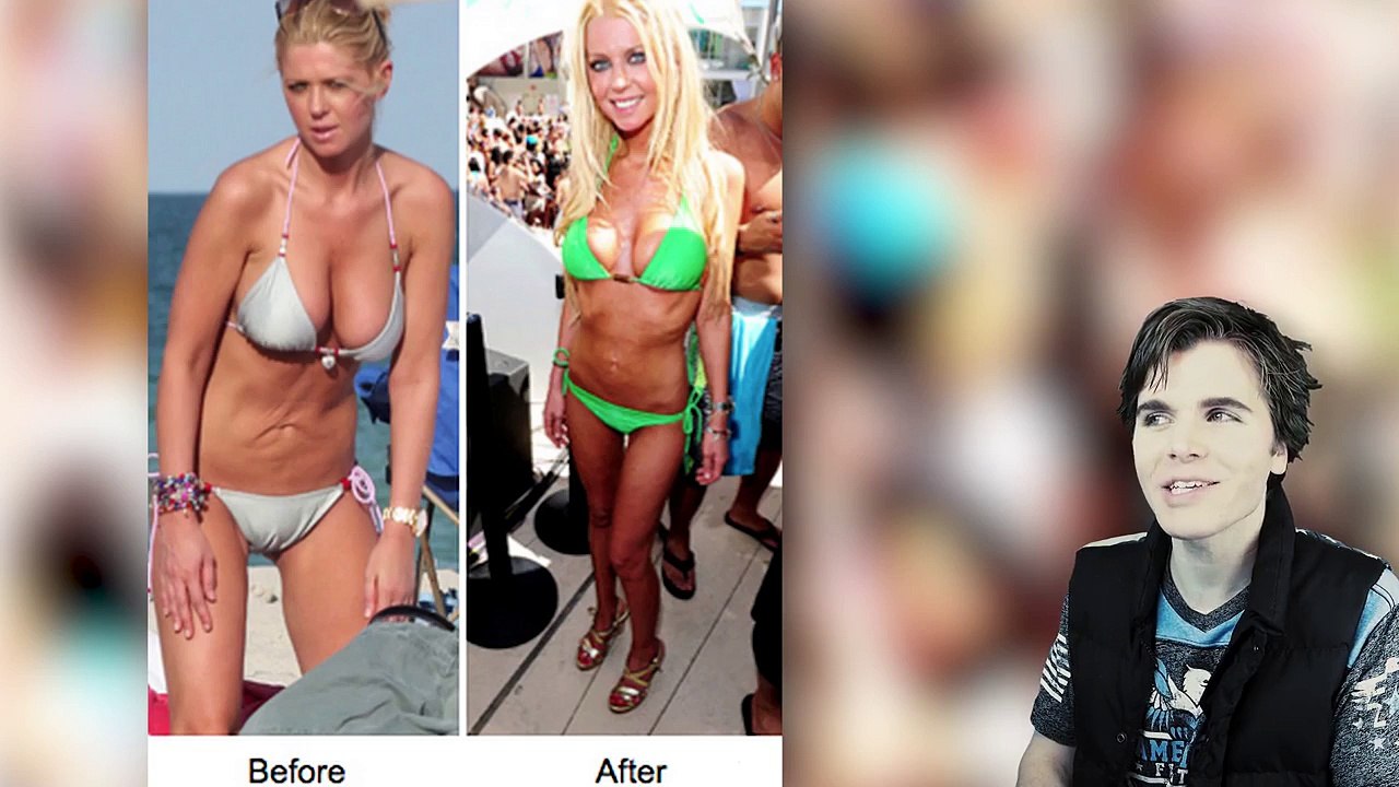 Bad Liposuction (Before And After)