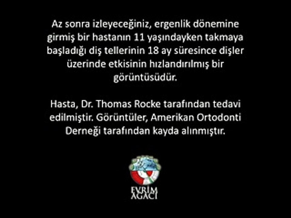 Diş Telinin Düzeltme Anları