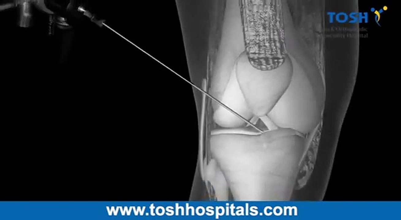 ACL surgery Chennai - Knee Replacement Surgery Cost in India