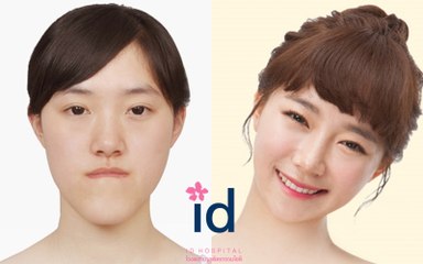 Let me in China, Orthognathic surgery before and after สาวจีนที่เคยโดนล้อว่ามนุษย์ต่างดาว ตอนนี้กลายมาเป็นนางฟ้าได้เพราะศัลยกรรม