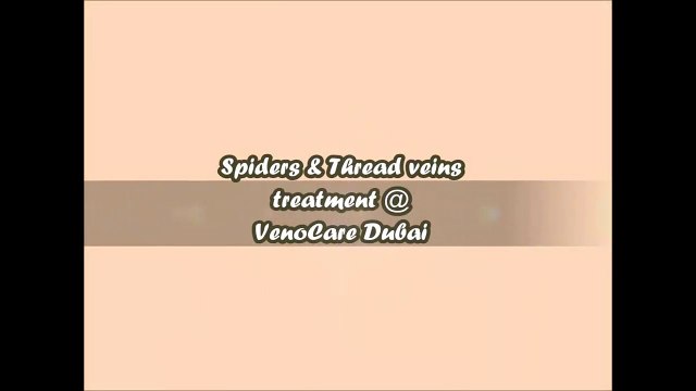 Laser Vein Removal for Getting Rid of Varicose Veins +971 52 993 6643