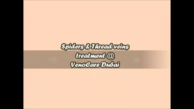Book Your EVLT Varicose Vein Laser Treatment for Varicose Veins in Legs +971 52 993 6643