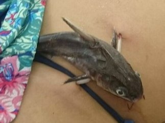 Genç Kızın Karnına Saplanan Balığı Ameliyatla Çıkardılar