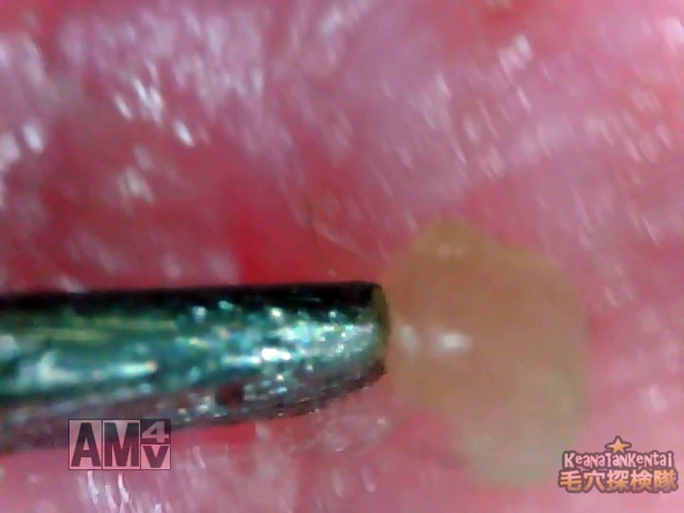 Pushing out a blackhead