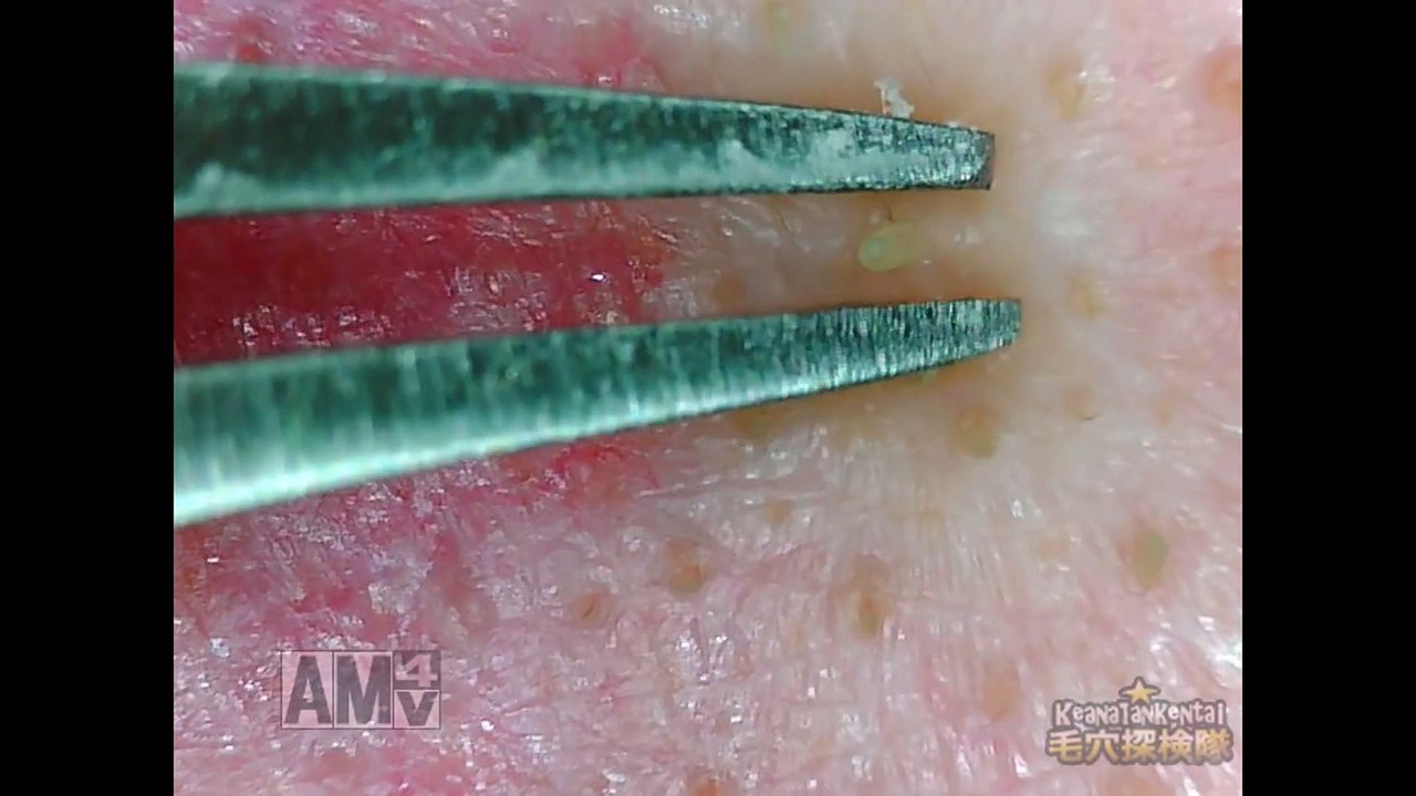 Blackhead removal at fixed point
