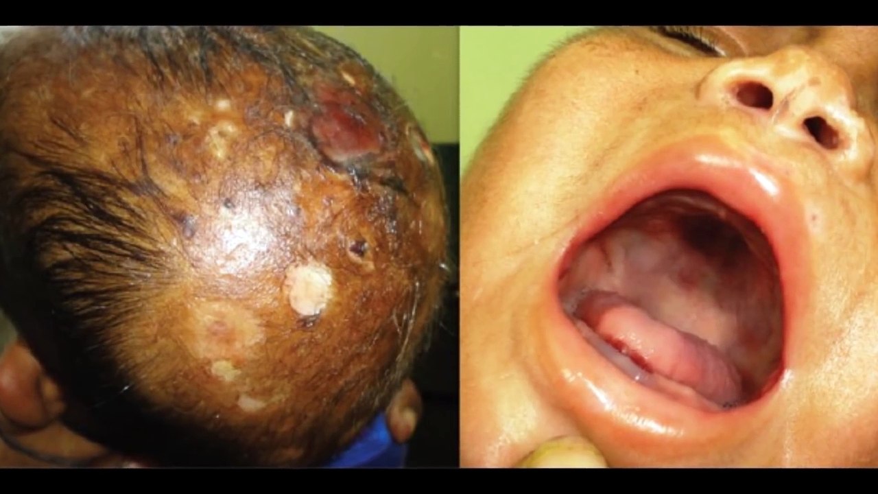 Blackhead, Black Heads and Blackheads!
