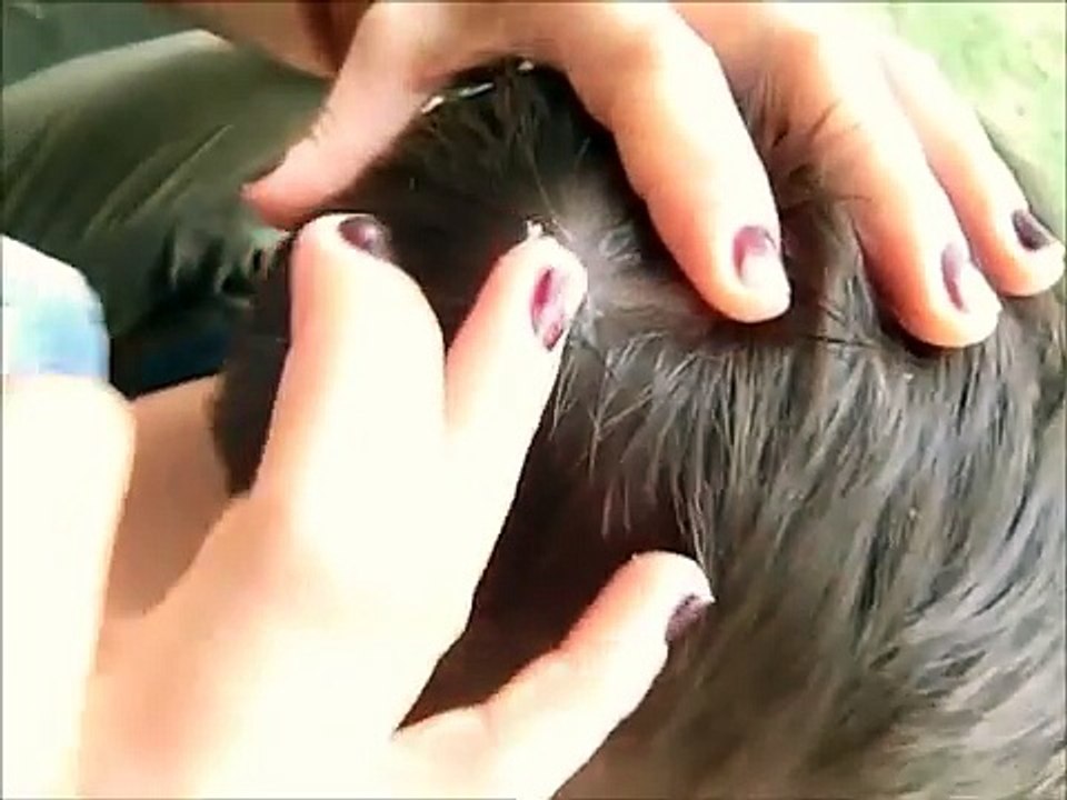 أشتكى من رأسه فذهب للطبيب ليخرج منها كائن مرعب  شاهد ماذا وجد داخل هذا الثقب