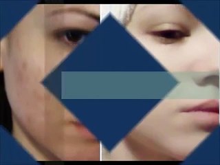 Receita caseira para eliminar espinhas do rosto