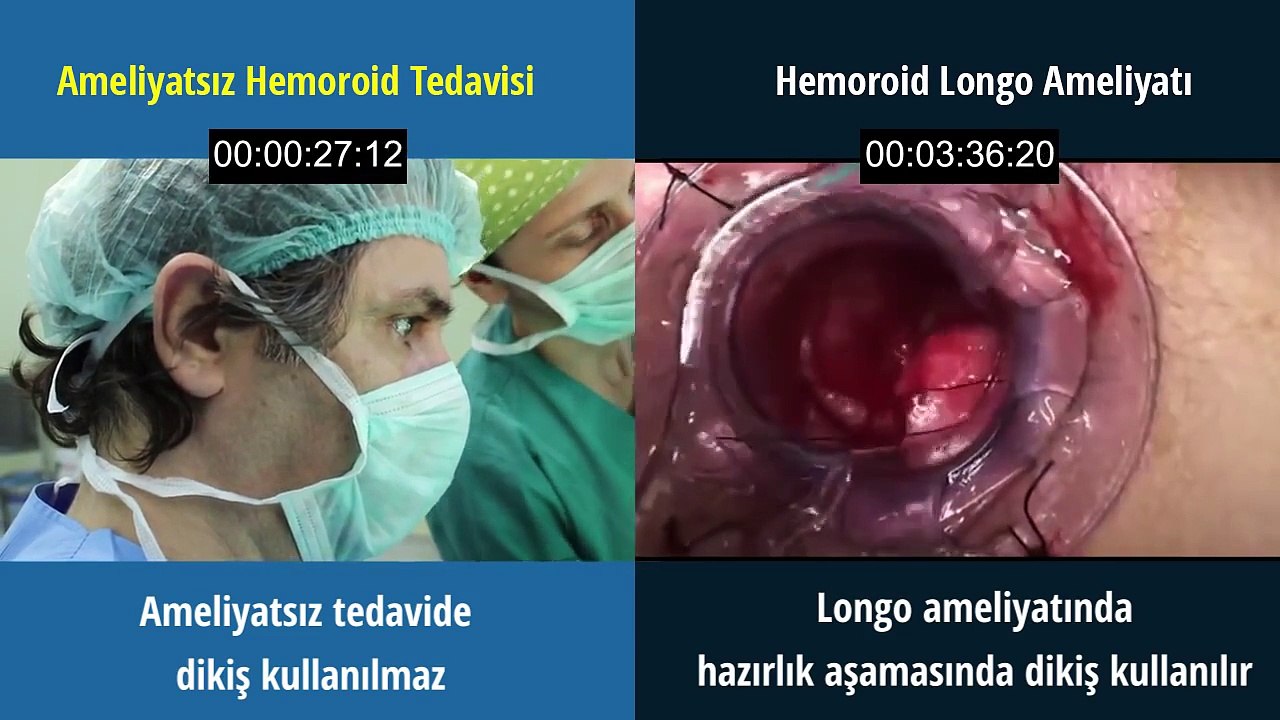 Hemoroid (Basur) Tedavisi
