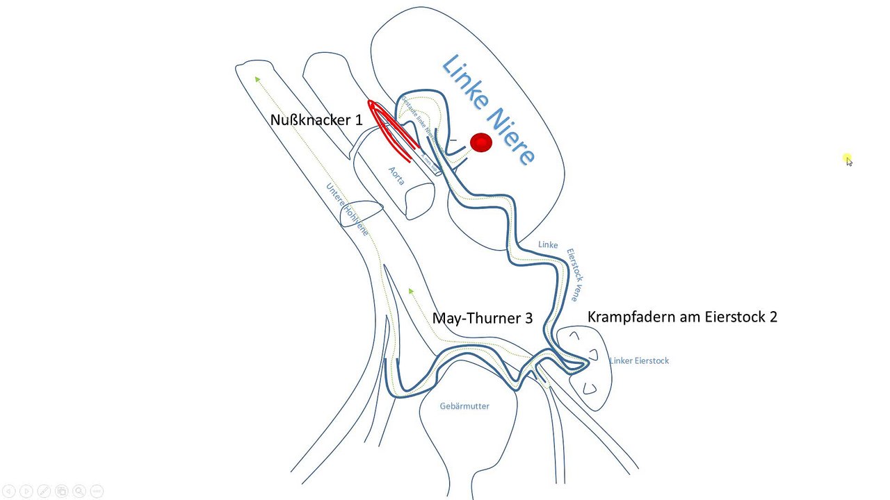 Nussknackerphänomen der linken Nierenvene - Umgehungskreislauf mit Engstellen