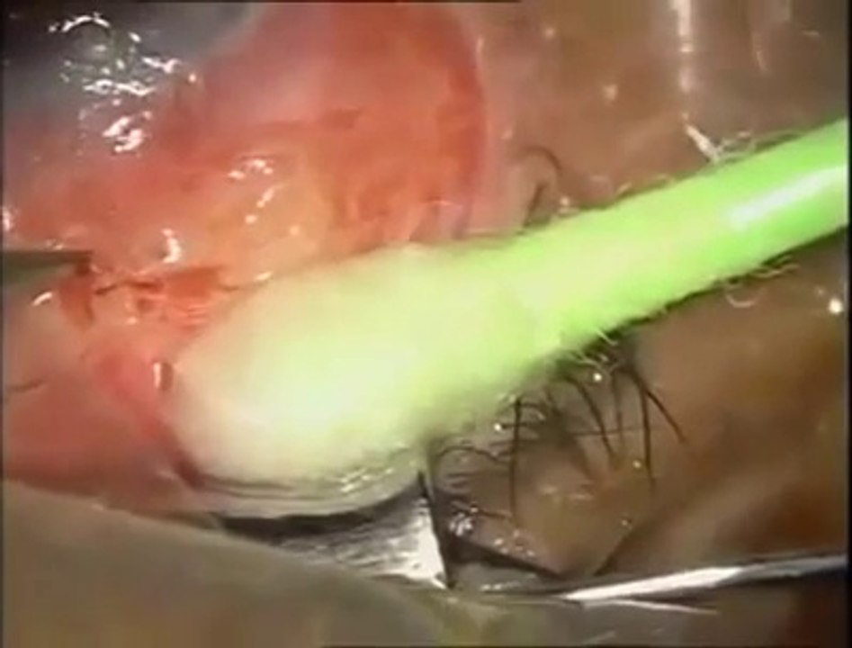 استخراج دوده من عين مريض