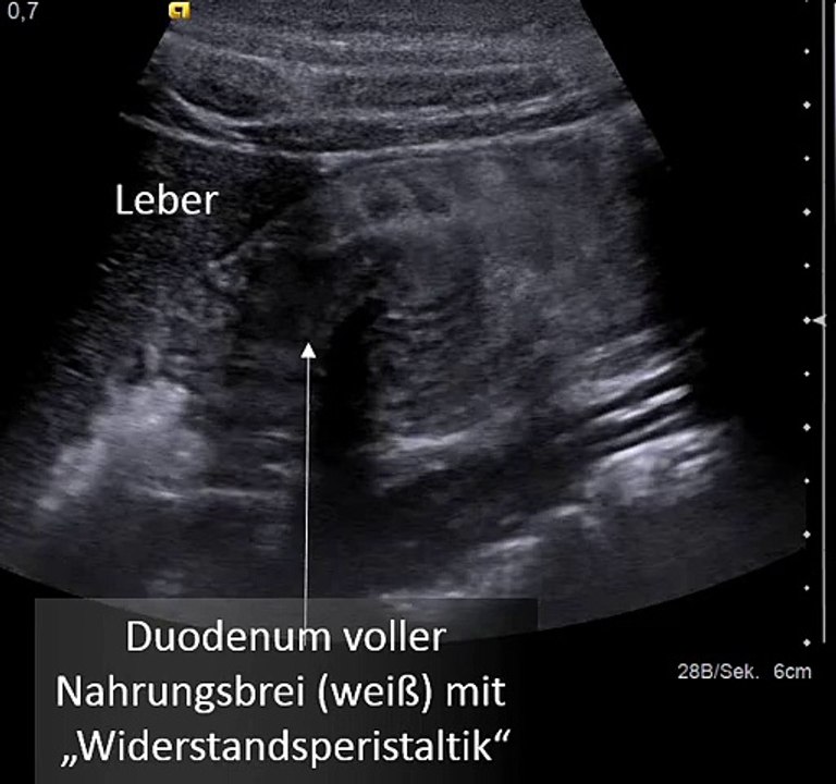 Duodenum nach Nahrungsaufnahme bei Wilkie-Syndrom: Widerstandsperistaltik