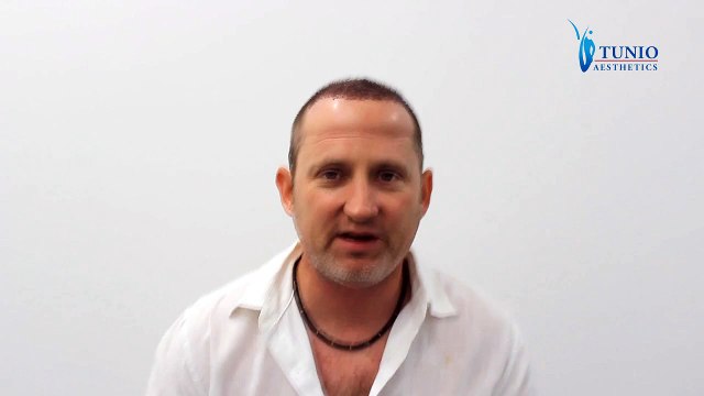 Adam Richard Belmont 2nd day of surgery - FUE Hair Transplant