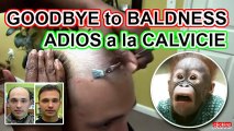 ¡INCREIBLE! COMO DEJAR de ser CALVO ya No soy calvo No soy pelon Goodbye Baldness peluca calva calvicie solución a la caida de pelo caida del pelo cabello melena loción crecepelo estafa timo remedio casero hair loss solution wig skalling