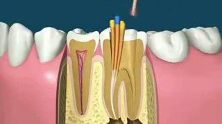 How Root Canal Treatment (RCT) Works
