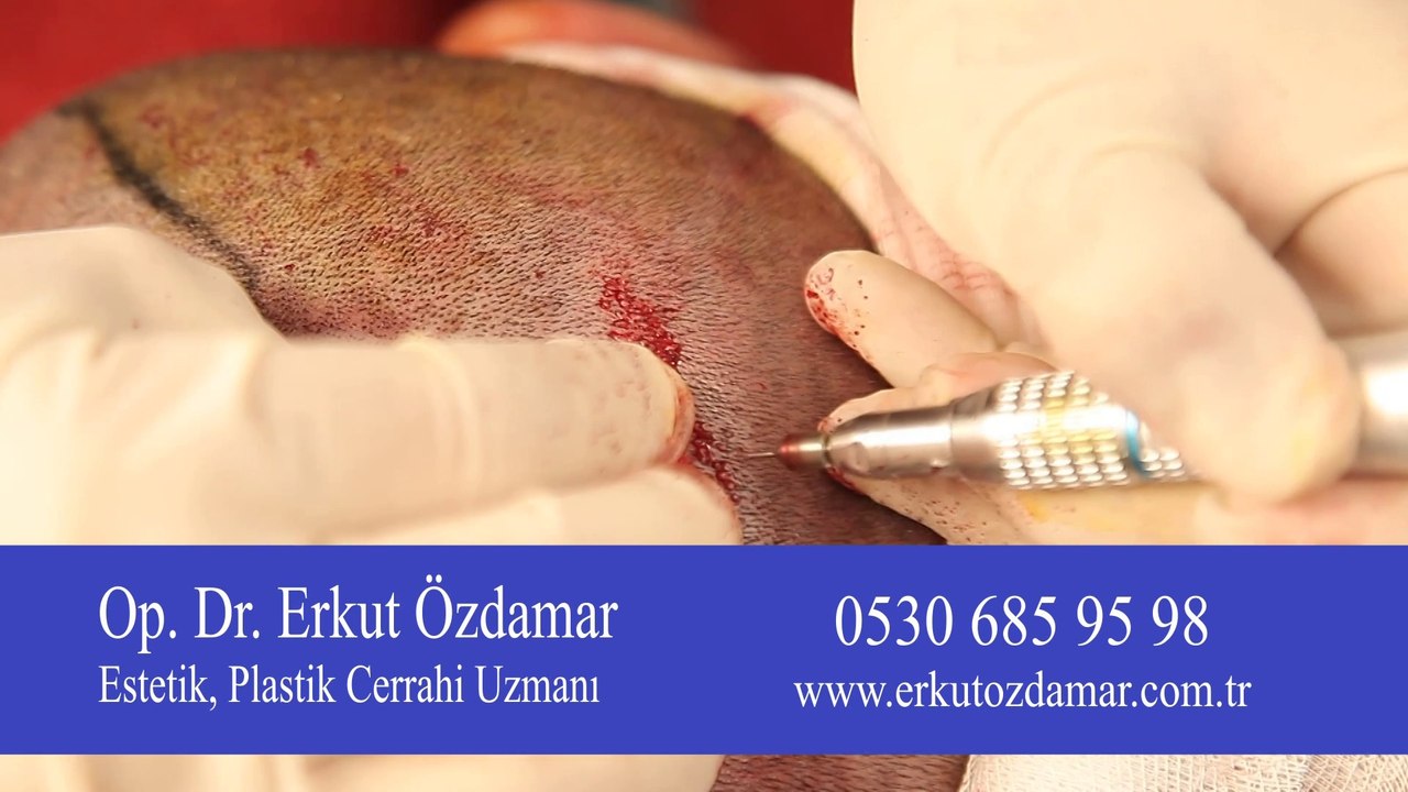 Saç ekimi nerede yapılmalıdır?