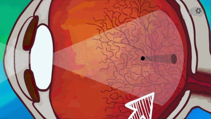 Это Работает | Что за мушки плавают перед глазами?