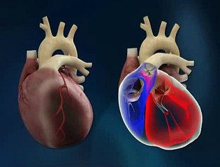 Coeur artificiel : le 4e patient greffé est mort