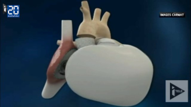 Le 4e patient greffé du coeur artificiel de Carmat est décédé