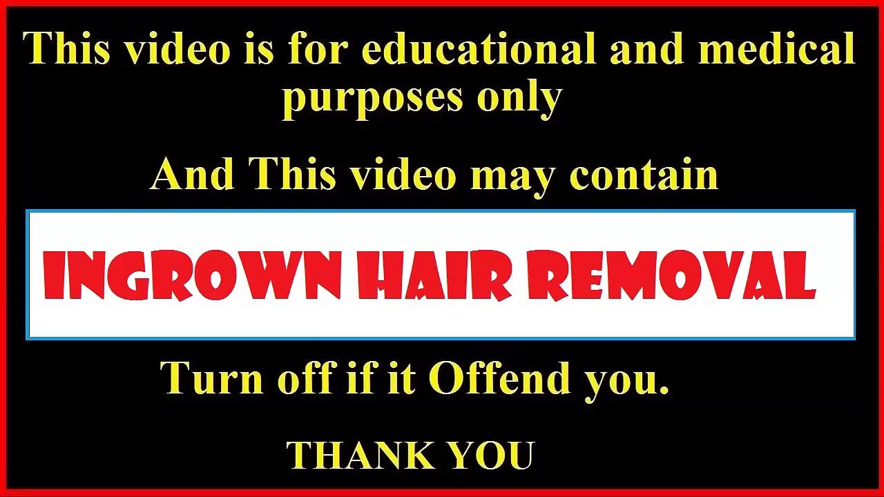 Ingrown Hair Removal | Ingrown hair treatment best compilation vol4