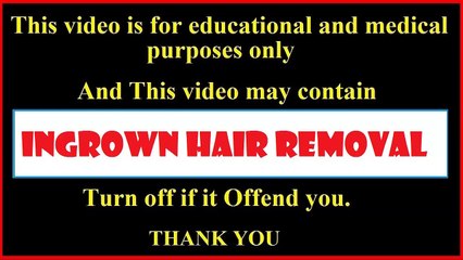 Ingrown Hair Removal | Ingrown hair treatment best compilation vol4