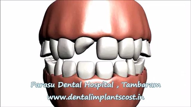 Smile Makeover Treatment Chennai India | Best Dental Clinic