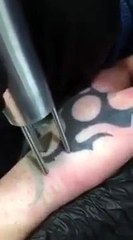 La machine la plus rapide du monde pour enlever les tatouages