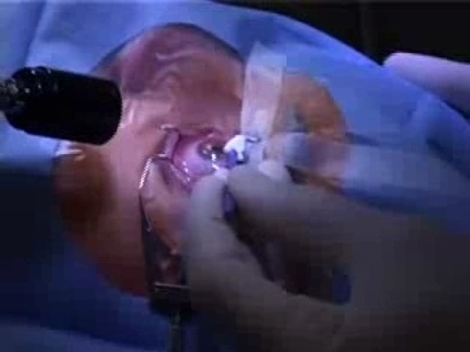 Opération Lasik