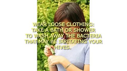 How To Get Rid Of Hives Fast