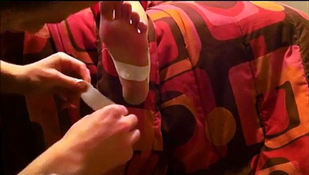 Taping for Plantar Fasciitis