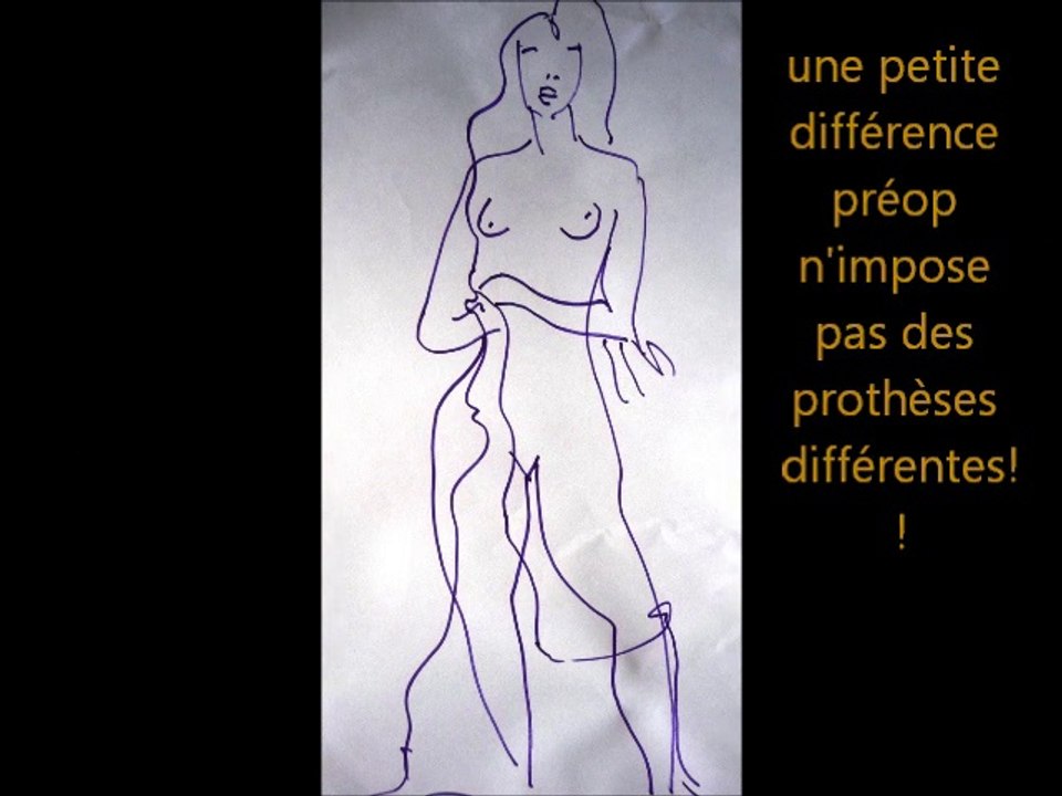 asymétrie mammaire, correction par vladimir mitz