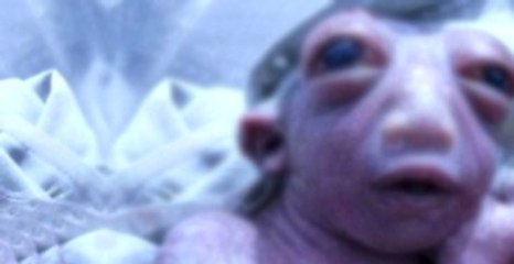 Başının Bir Kısmı Olmadan Dünyaya Gelen Bebek Hayatını Kaybetti