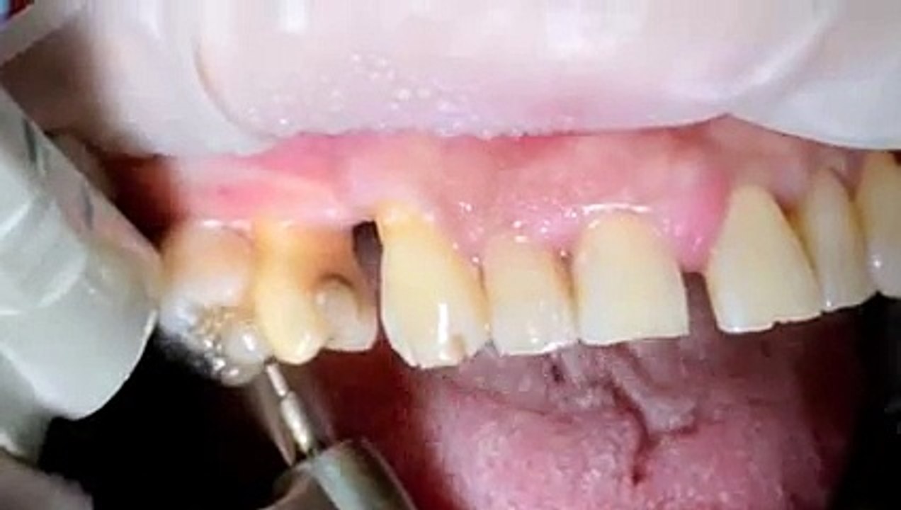 Cas clinique Bridge Céramique Cerec direct et PAG, Dr Jacques Raynal