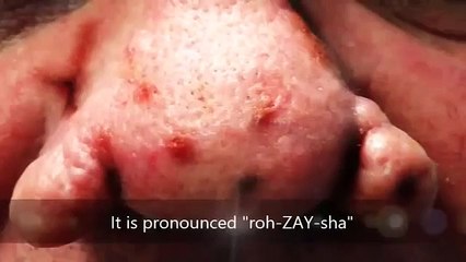 Rosacea Answers   What is Rosacea