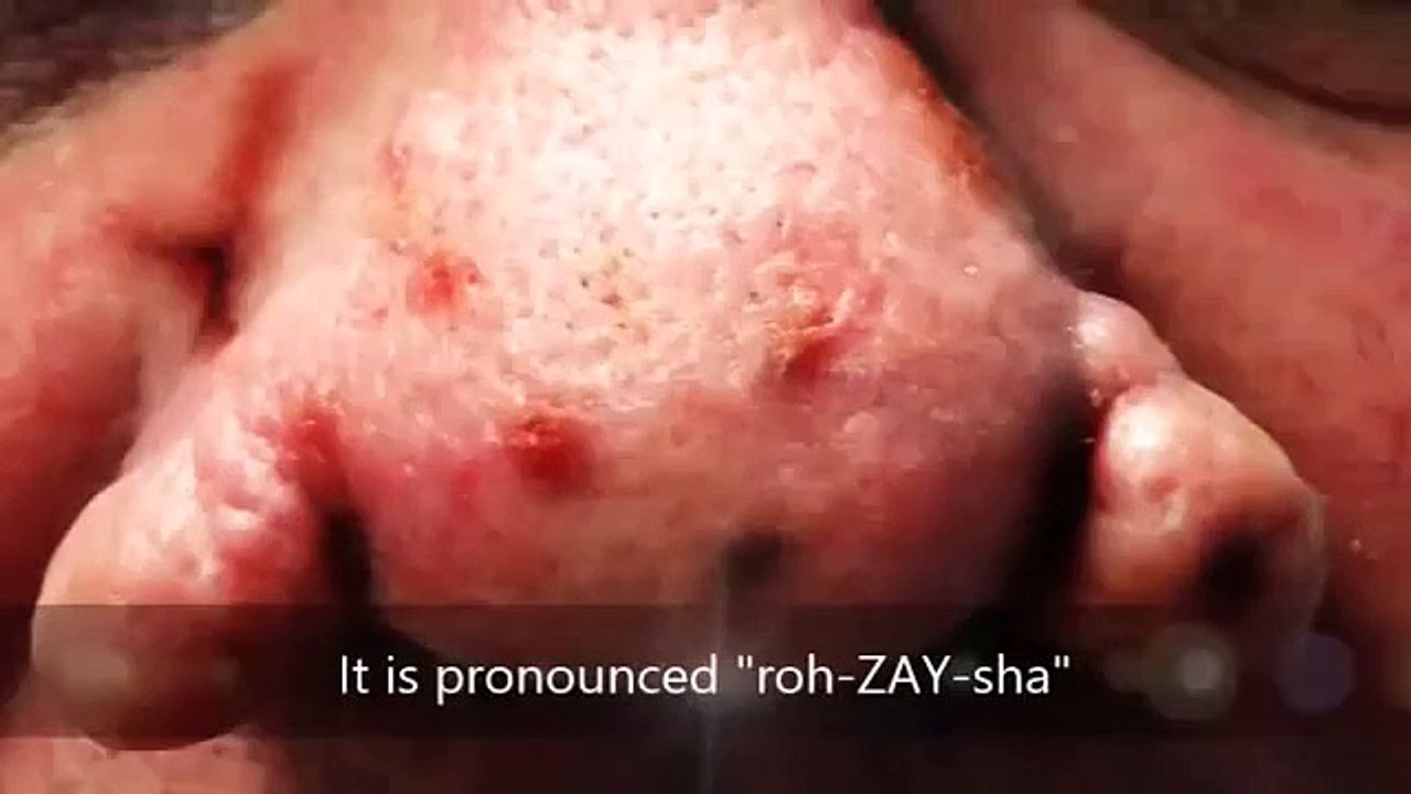 Rosacea Answers   What is Rosacea