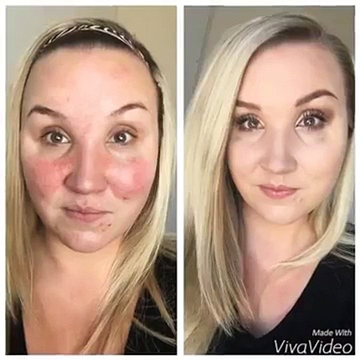 How to cover up acne, acne scars, rosacea and imperfections with naturally based makeup.