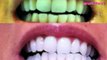 My TEETH (Before & After) Invisalign, Zoom Teeth Whitening, Veneers