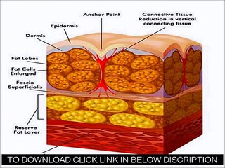 What Is The Cellulite Factor Solution Review