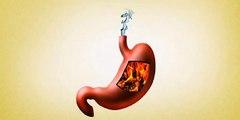 The Permanent Acid Reflux Remedy Solution - Reverse your Acid Reflux Safely, Naturally, and Today!