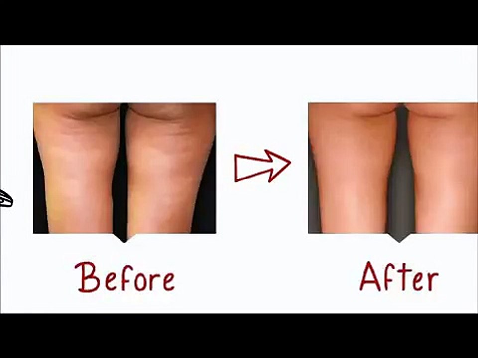 Cellulite Factor Solution Review Guides
