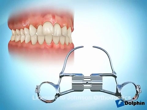 Çarpık, Yamuk Diş Tedavisi İle Dişler Nasıl Düzeltilir? - Dr. Hakan Dönmez