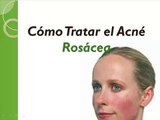 Remedios caseros para eliminar el acne Rosacea