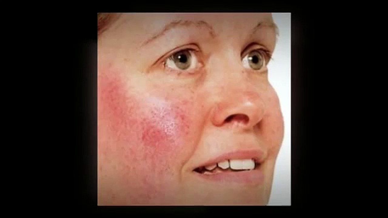 Different Types of Rosacea Symptoms