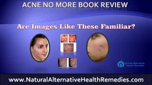 Acne No More Book Review Reveals How To Treat and Cure Acne