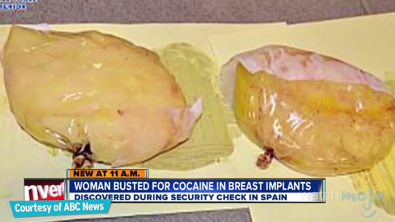 Top 5 Facts About Breast Implants