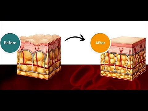 Cellulite Factor Solution Reviews BY Dr Charles